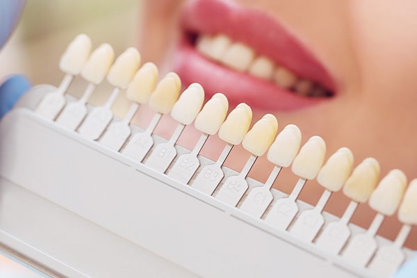Cavanagh Dental - Teeth Whitening